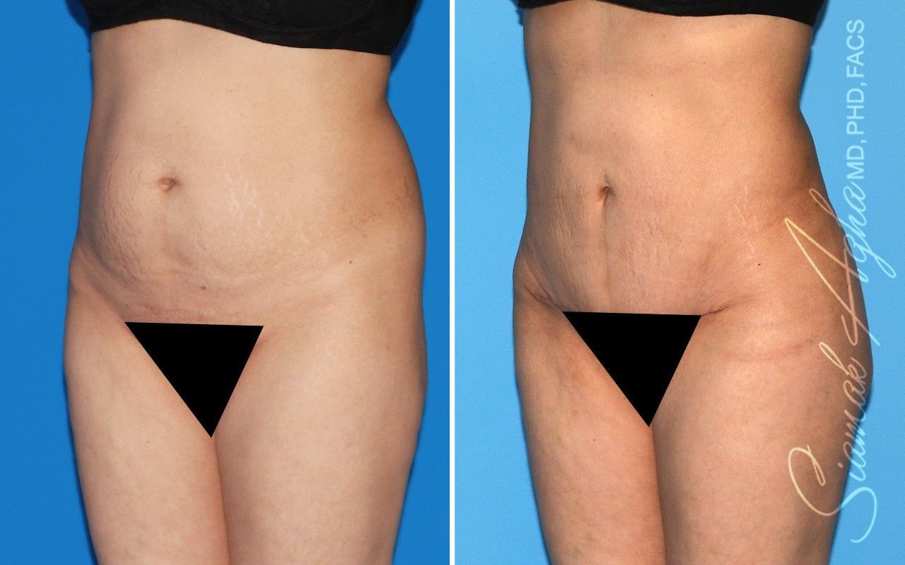 Combined Tummy Tuck Brazilian Butt Lift Before & After