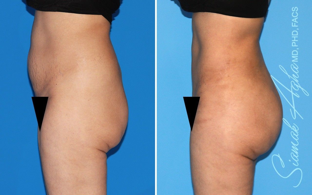 Combined Tummy Tuck Brazilian Butt Lift Before & After