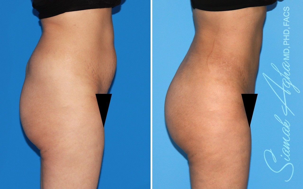 Combined Tummy Tuck Brazilian Butt Lift Before & After