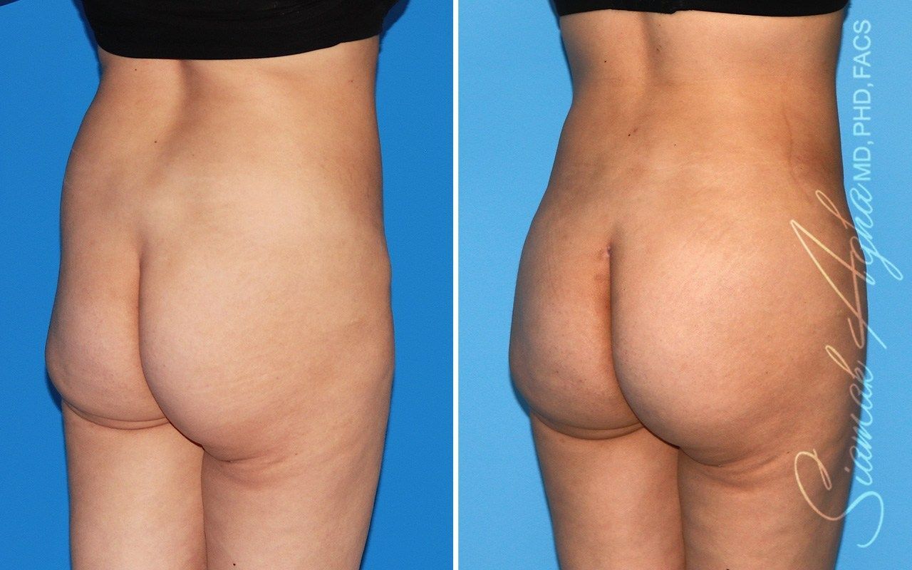 Combined Tummy Tuck Brazilian Butt Lift Before & After