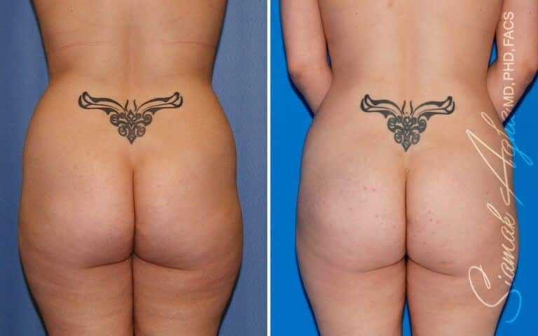Combined Tummy Tuck Brazilian Butt Lift Before & After
