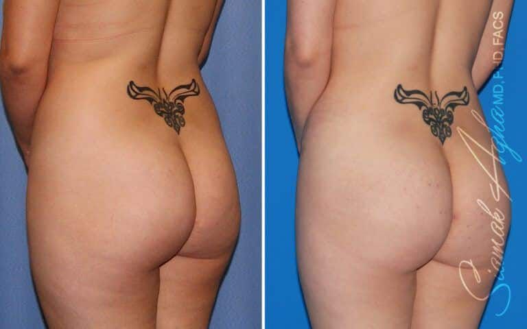 Combined Tummy Tuck Brazilian Butt Lift Before & After