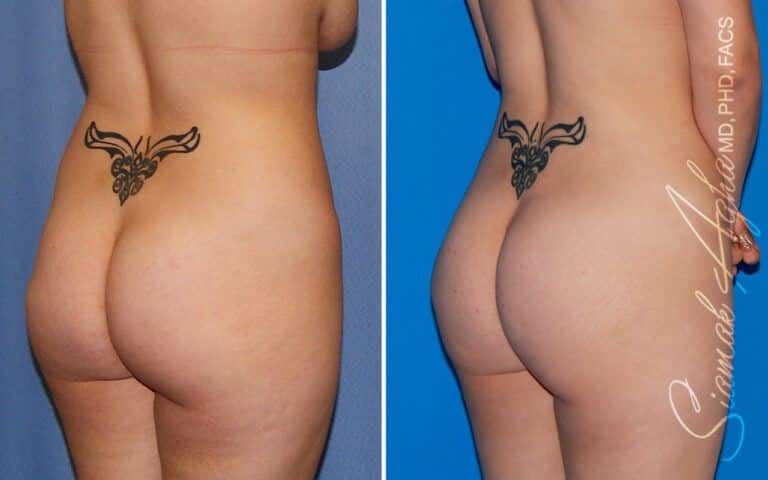 Combined Tummy Tuck Brazilian Butt Lift Before & After