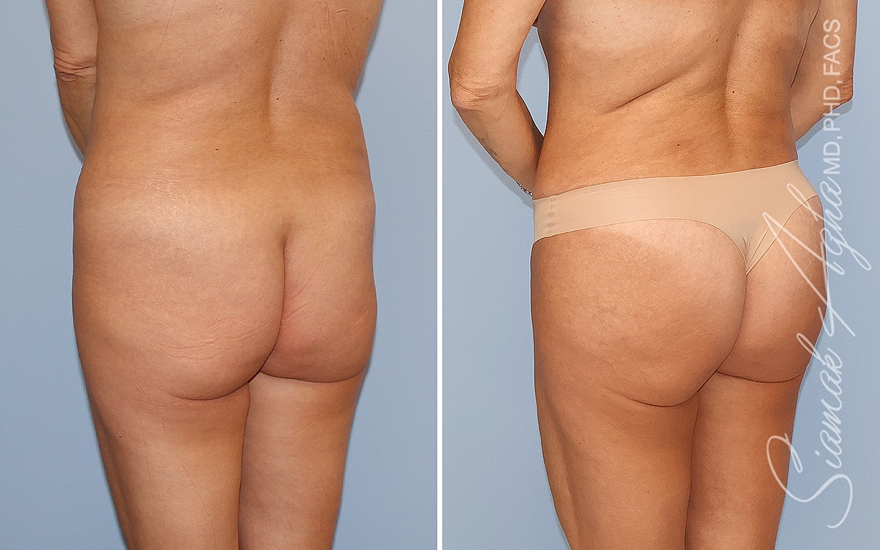 Combined Tummy Tuck Brazilian Butt Lift Before & After
