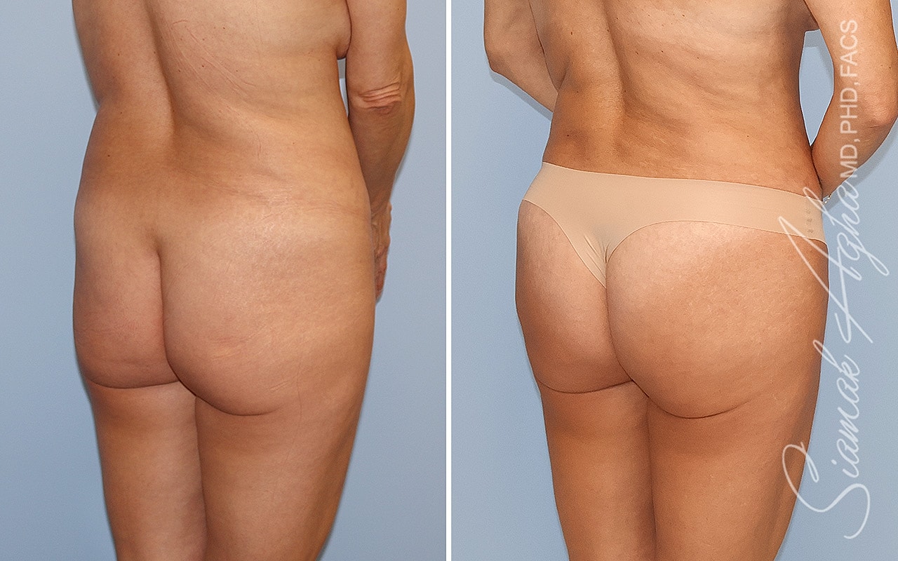 Combined Tummy Tuck Brazilian Butt Lift Before & After