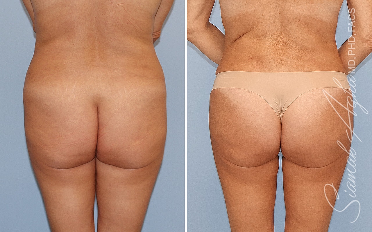 Combined Tummy Tuck Brazilian Butt Lift Before & After