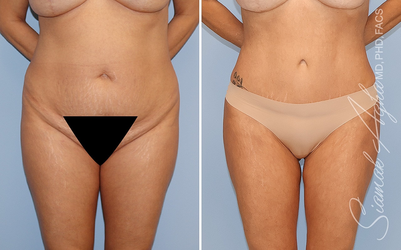 Combined Tummy Tuck Brazilian Butt Lift Before & After
