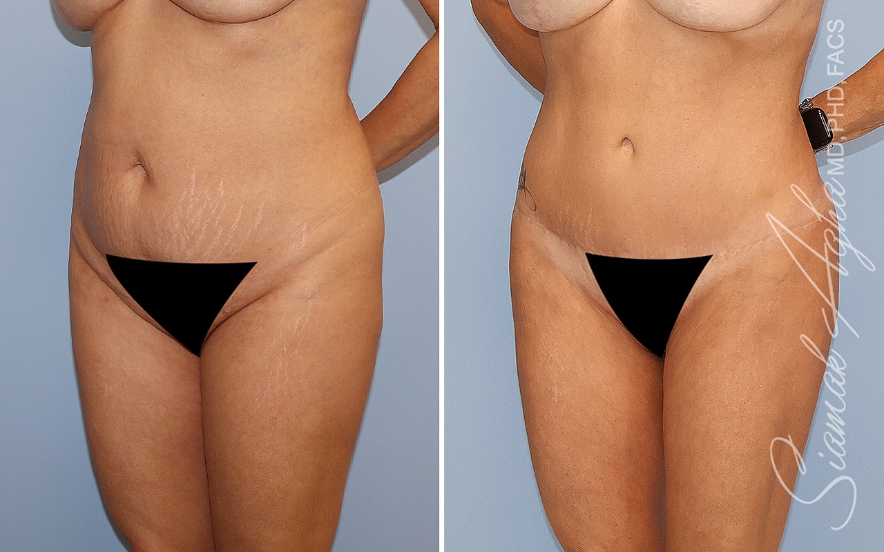 Combined Tummy Tuck Brazilian Butt Lift Before & After