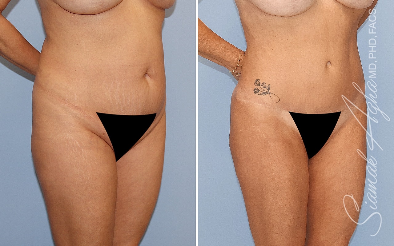Combined Tummy Tuck Brazilian Butt Lift Before & After