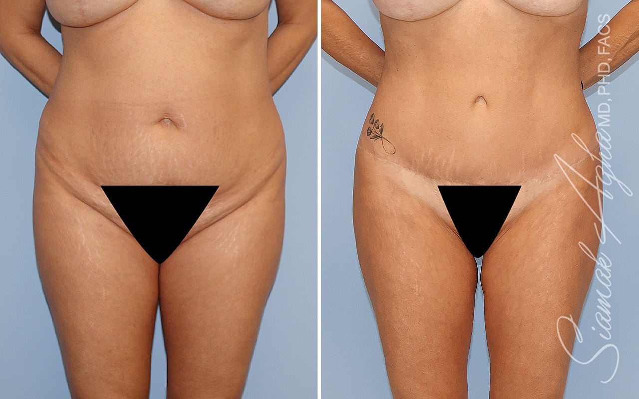 Combined Tummy Tuck Brazilian Butt Lift Before & After