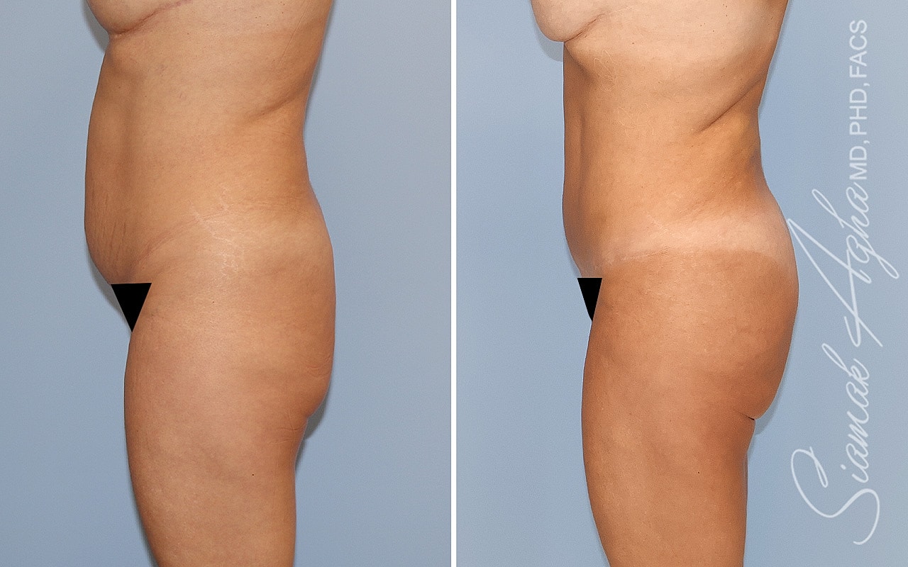 Combined Tummy Tuck Brazilian Butt Lift Before & After