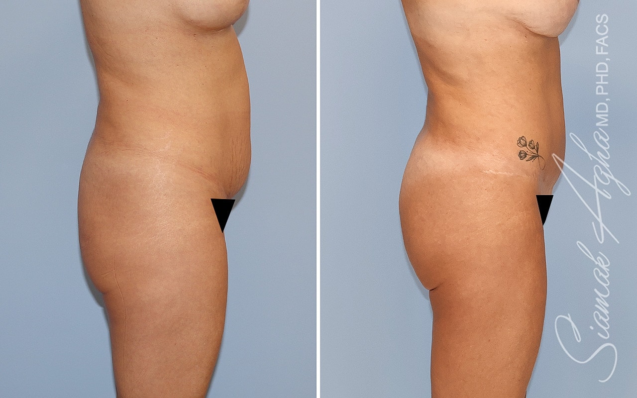 Combined Tummy Tuck Brazilian Butt Lift Before & After