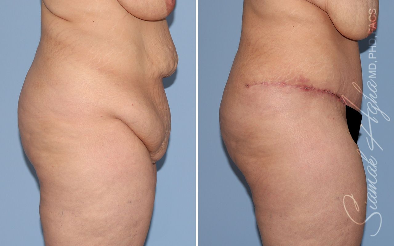 Plus Size Tummy Tuck Before & After