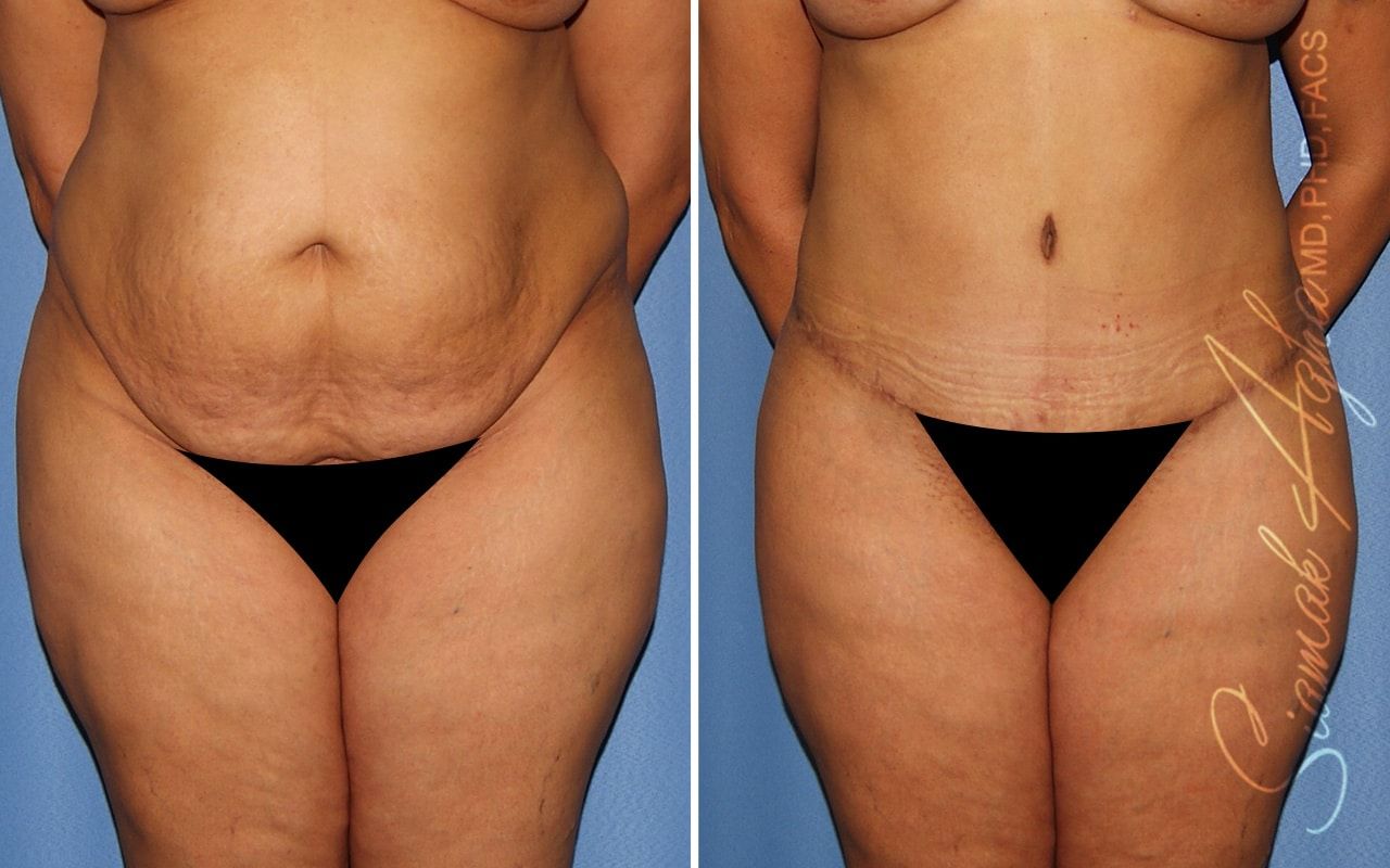 Plus Size Tummy Tuck Before & After