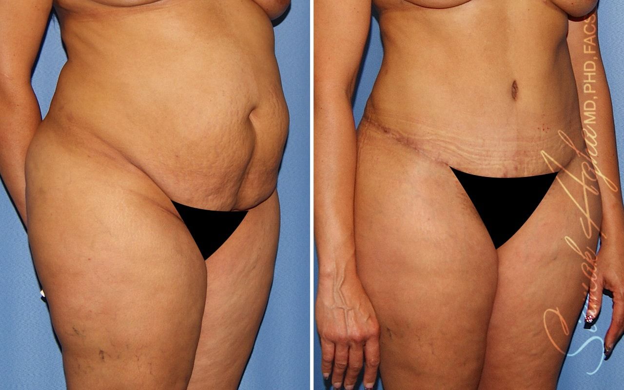Plus Size Tummy Tuck Before & After