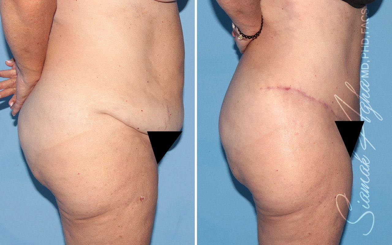 Plus Size Tummy Tuck Before & After