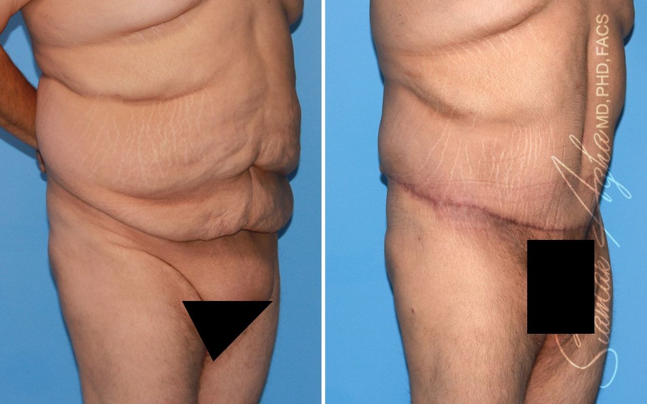 Plus Size Tummy Tuck Before & After