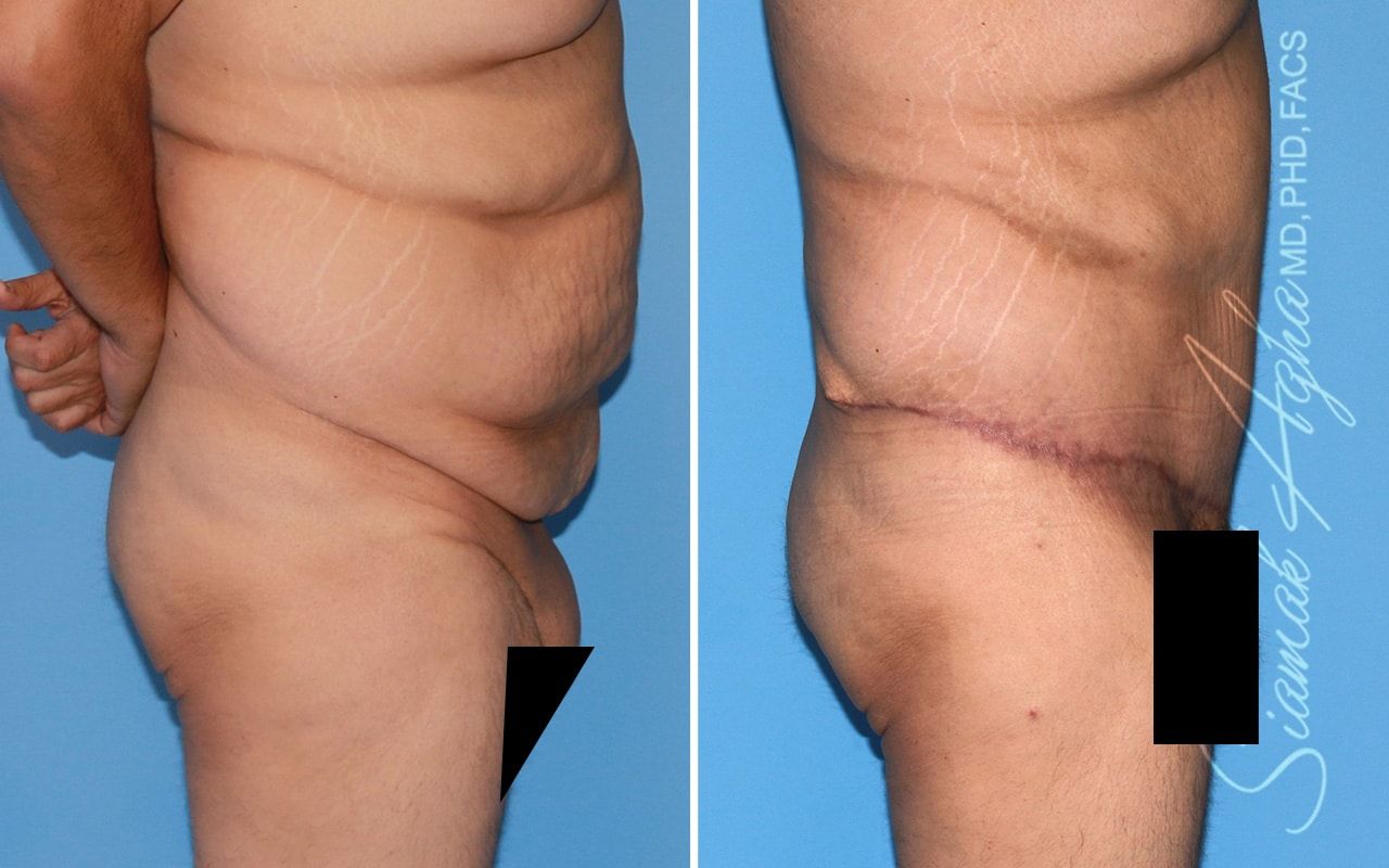 Plus Size Tummy Tuck Before & After