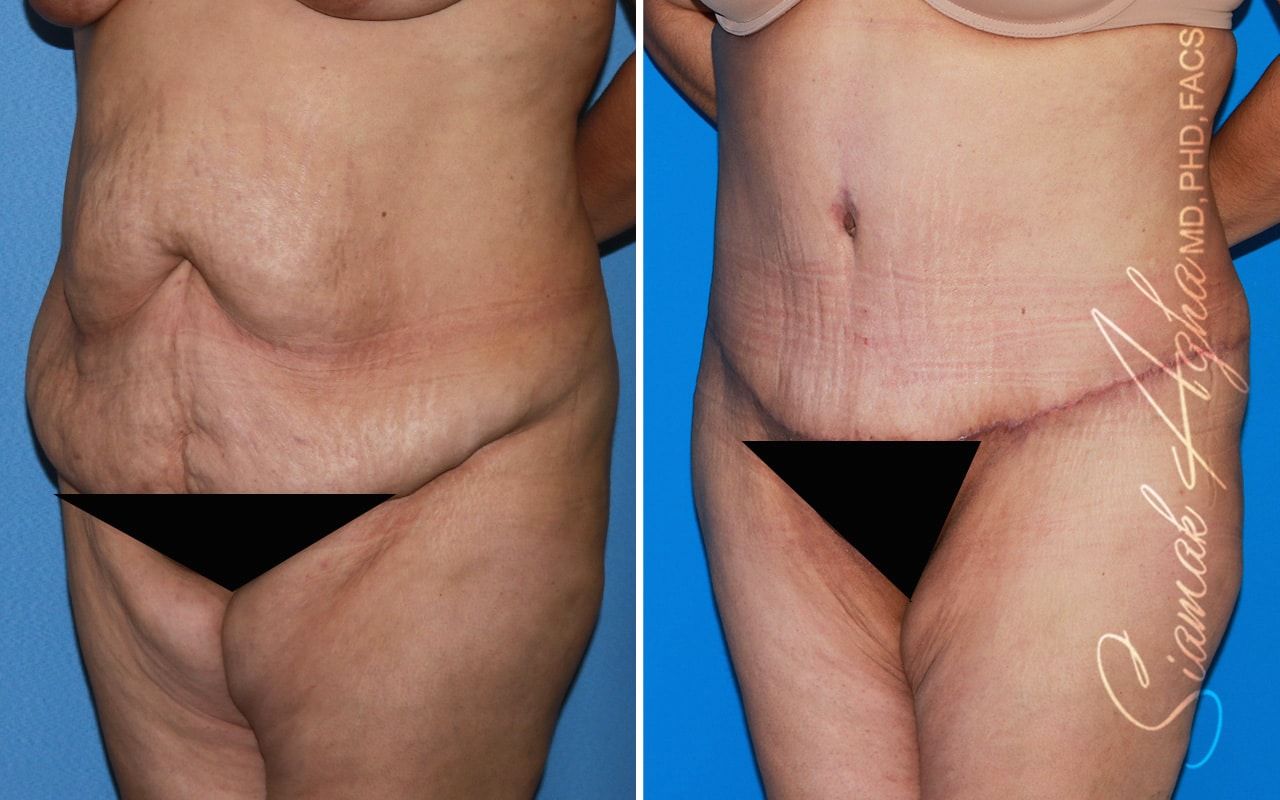 Plus Size Tummy Tuck Before & After