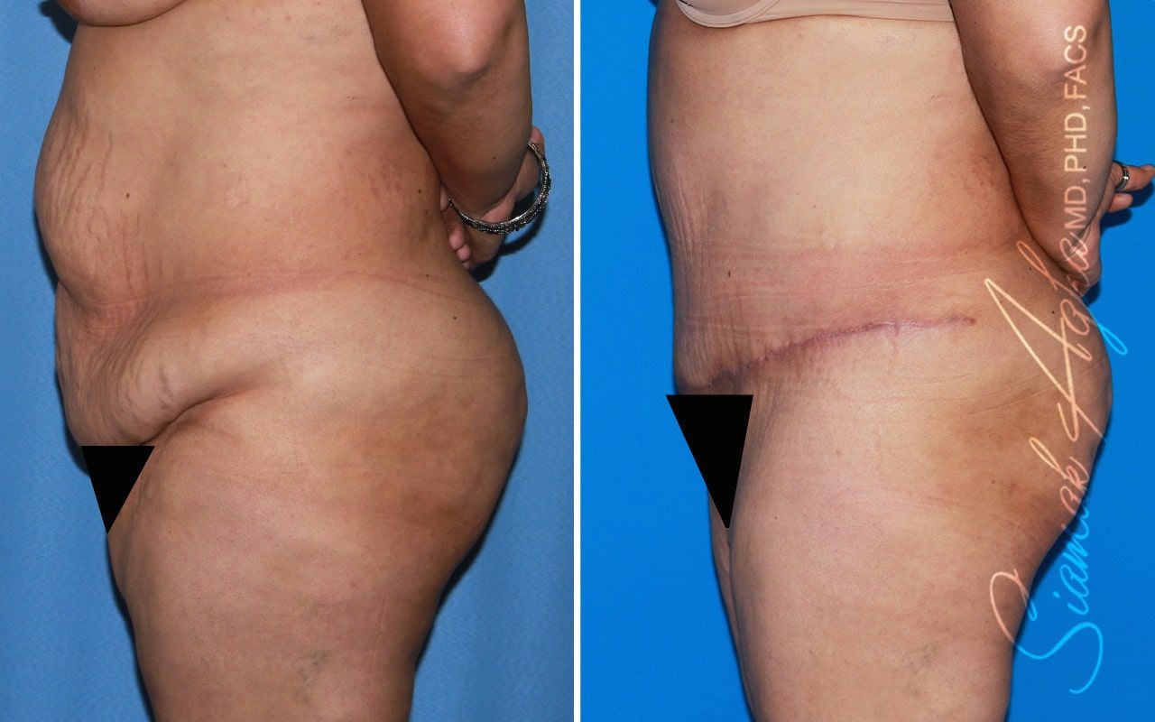 Plus Size Tummy Tuck Before & After