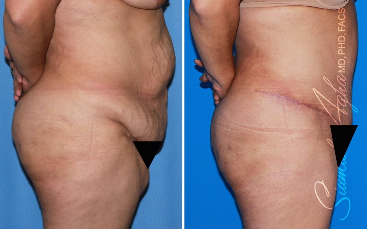 Plus Size Tummy Tuck Before & After