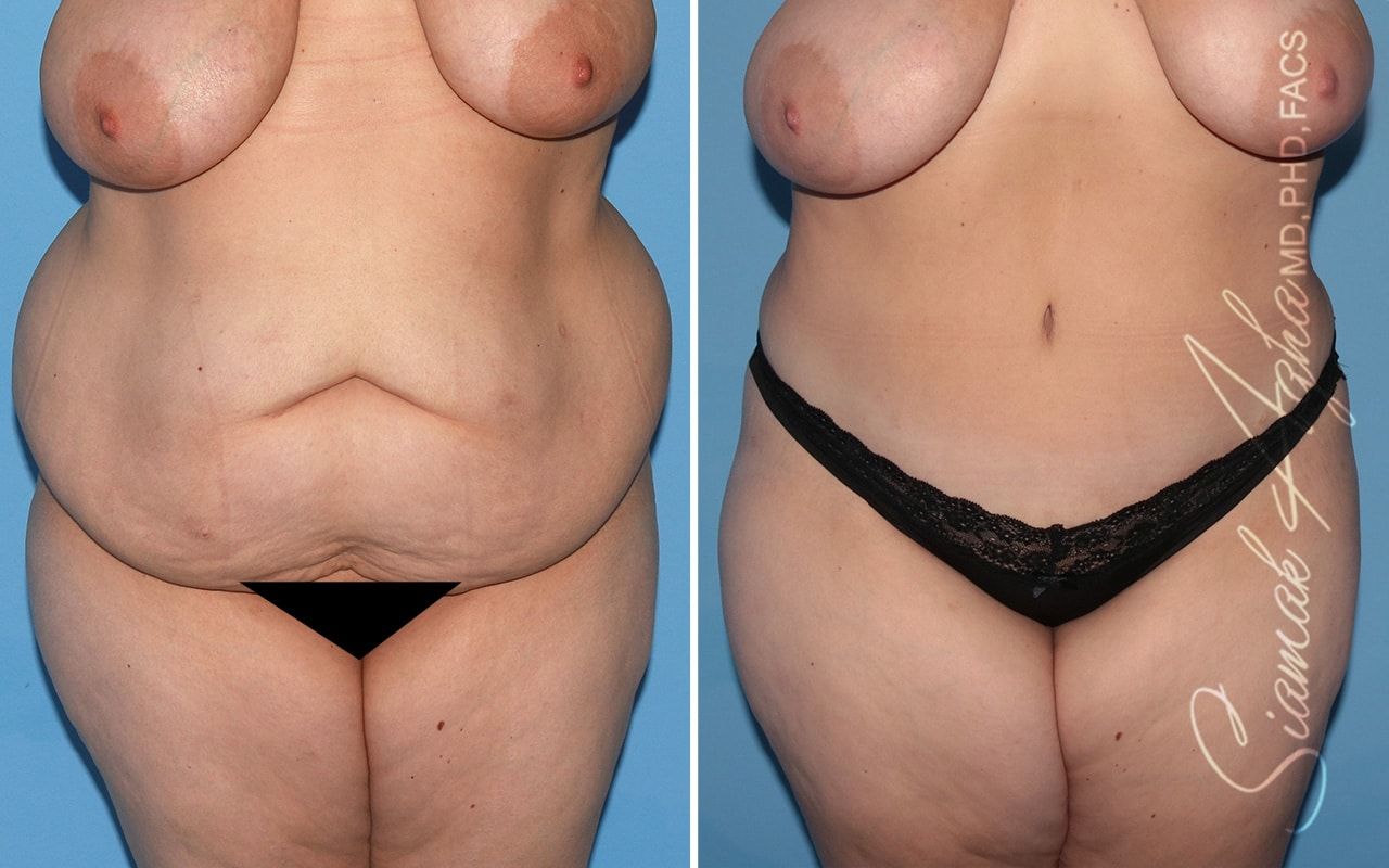 Plus Size Tummy Tuck Before & After