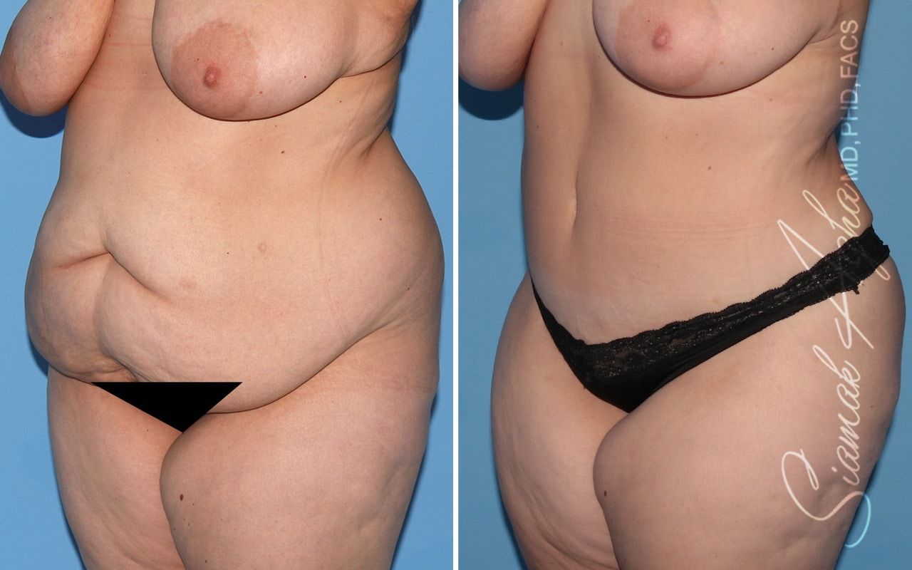 Plus Size Tummy Tuck Before & After