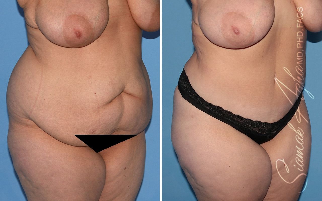 Plus Size Tummy Tuck Before & After