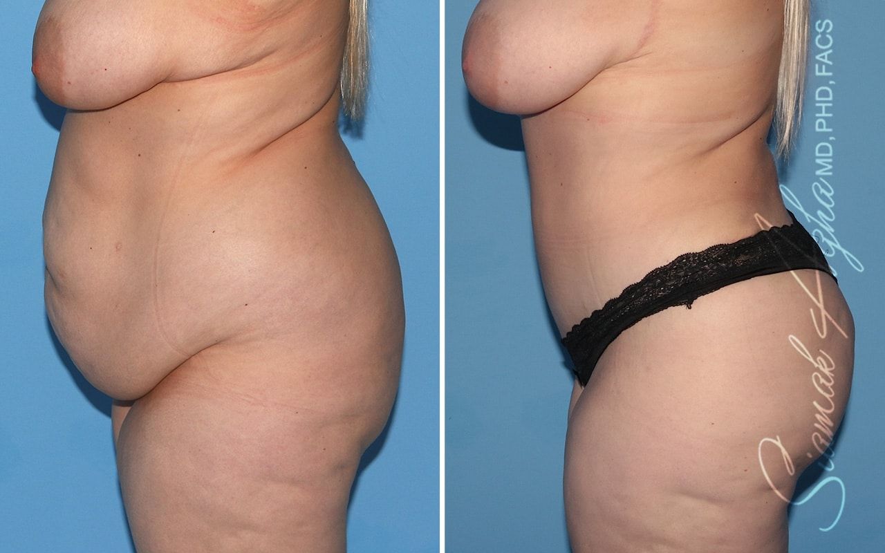 Plus Size Tummy Tuck Before & After