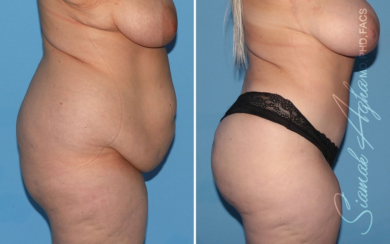 Plus Size Tummy Tuck Before & After