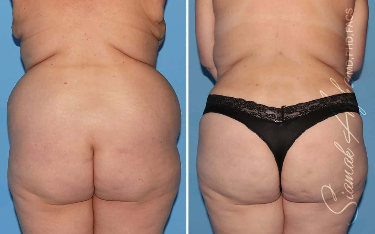 Plus Size Tummy Tuck Before & After