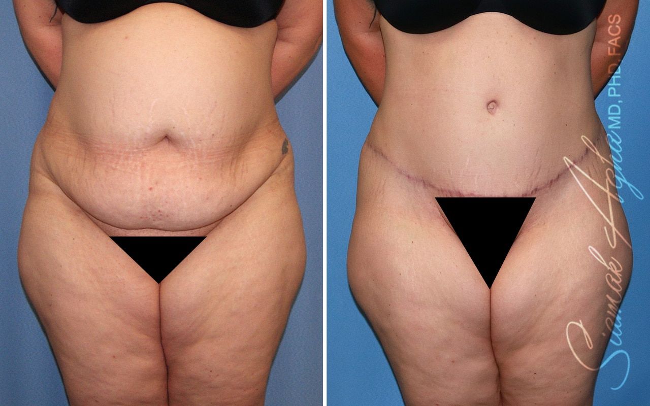 Plus Size Tummy Tuck Before & After