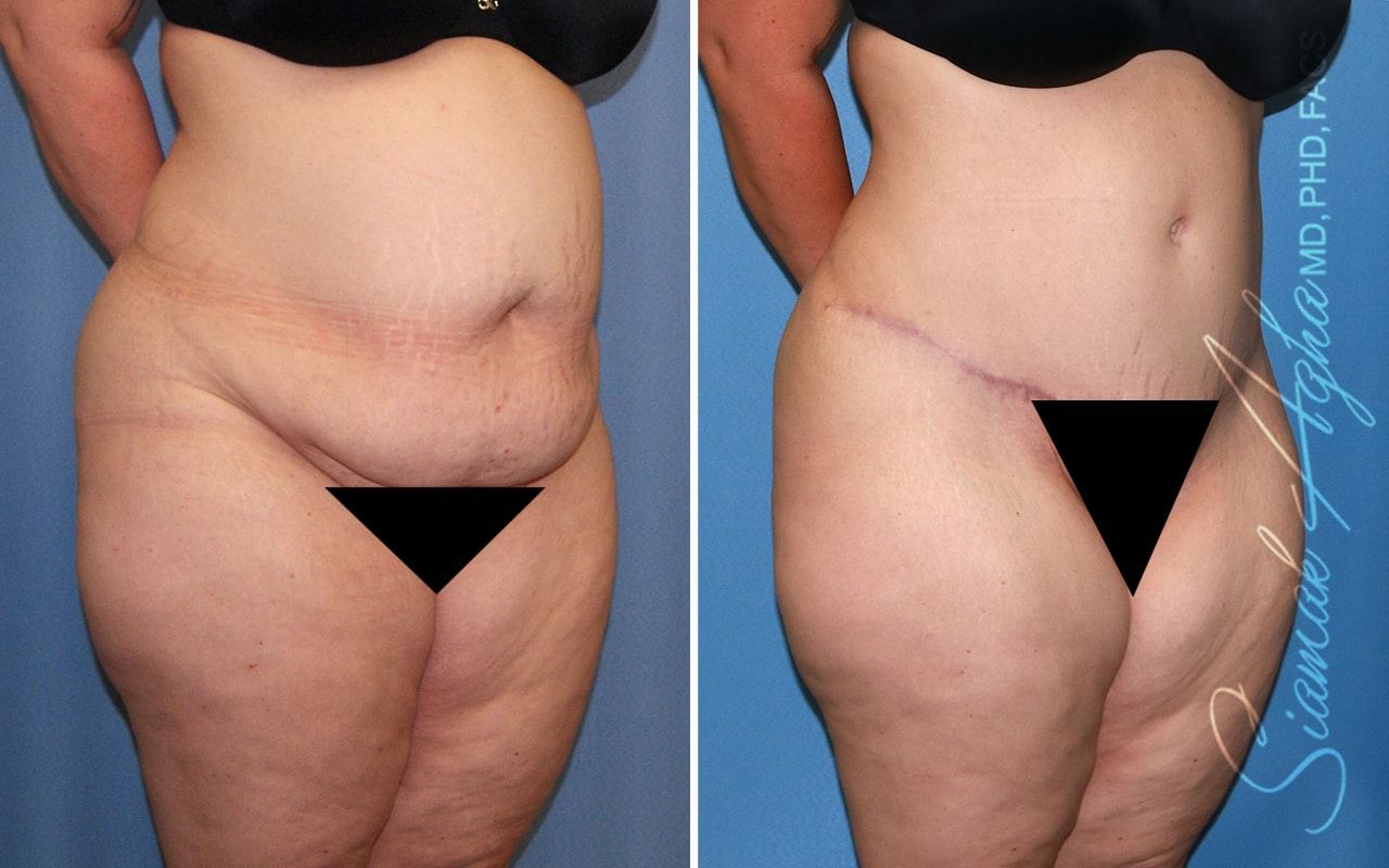Plus Size Tummy Tuck Before & After