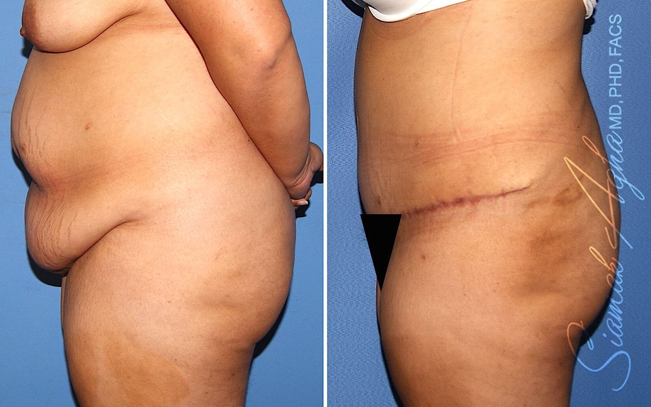 Plus Size Tummy Tuck Before & After