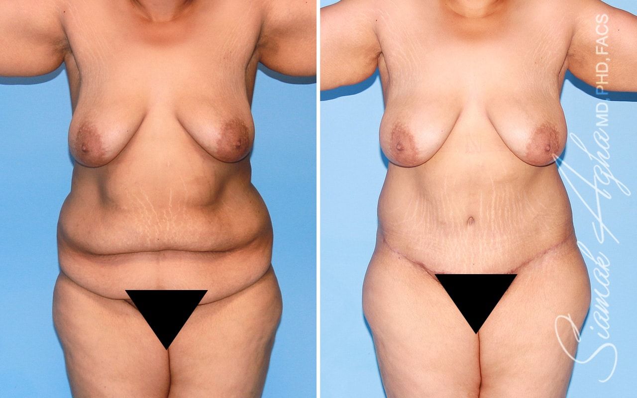 Plus Size Tummy Tuck Before & After
