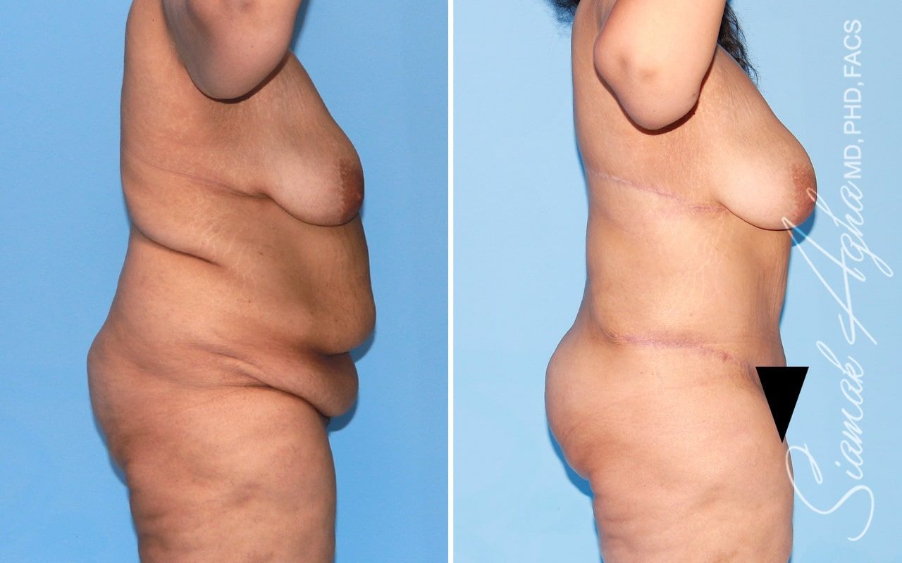 Plus Size Tummy Tuck Before & After