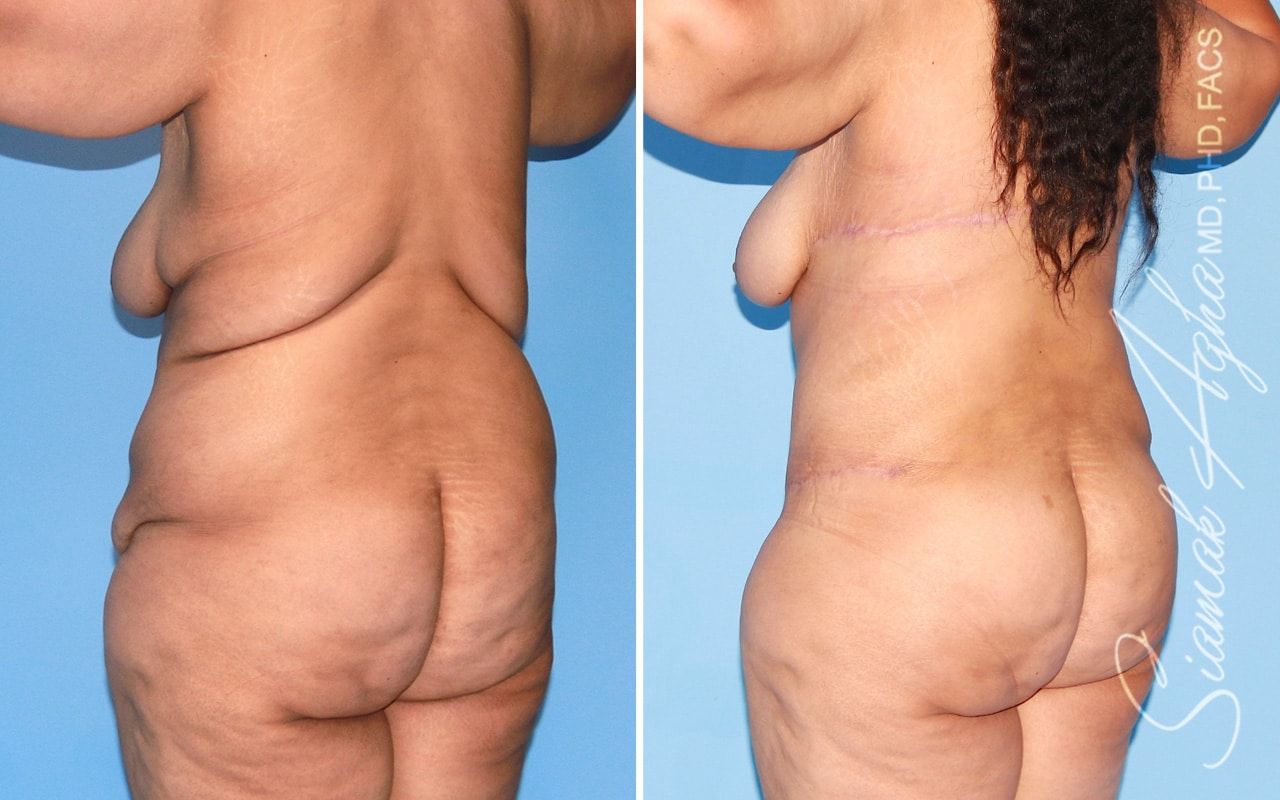 Plus Size Tummy Tuck Before & After