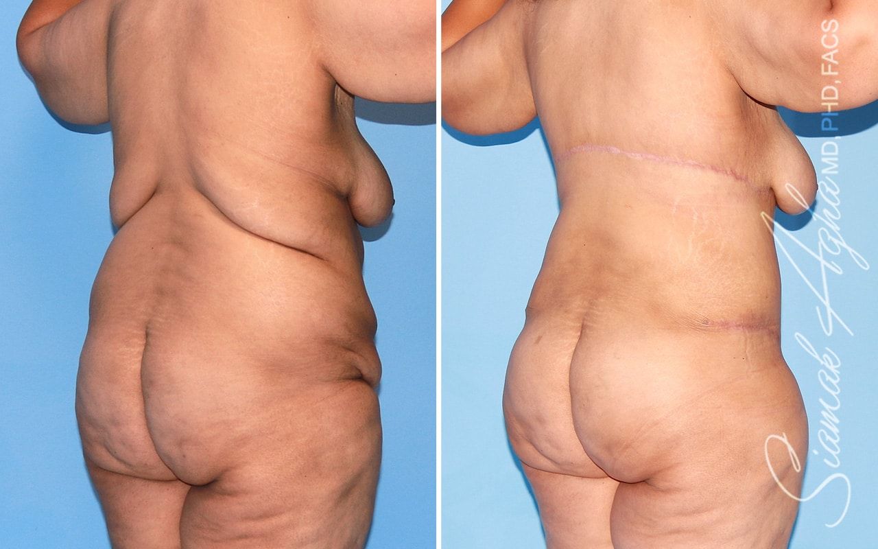 Plus Size Tummy Tuck Before & After