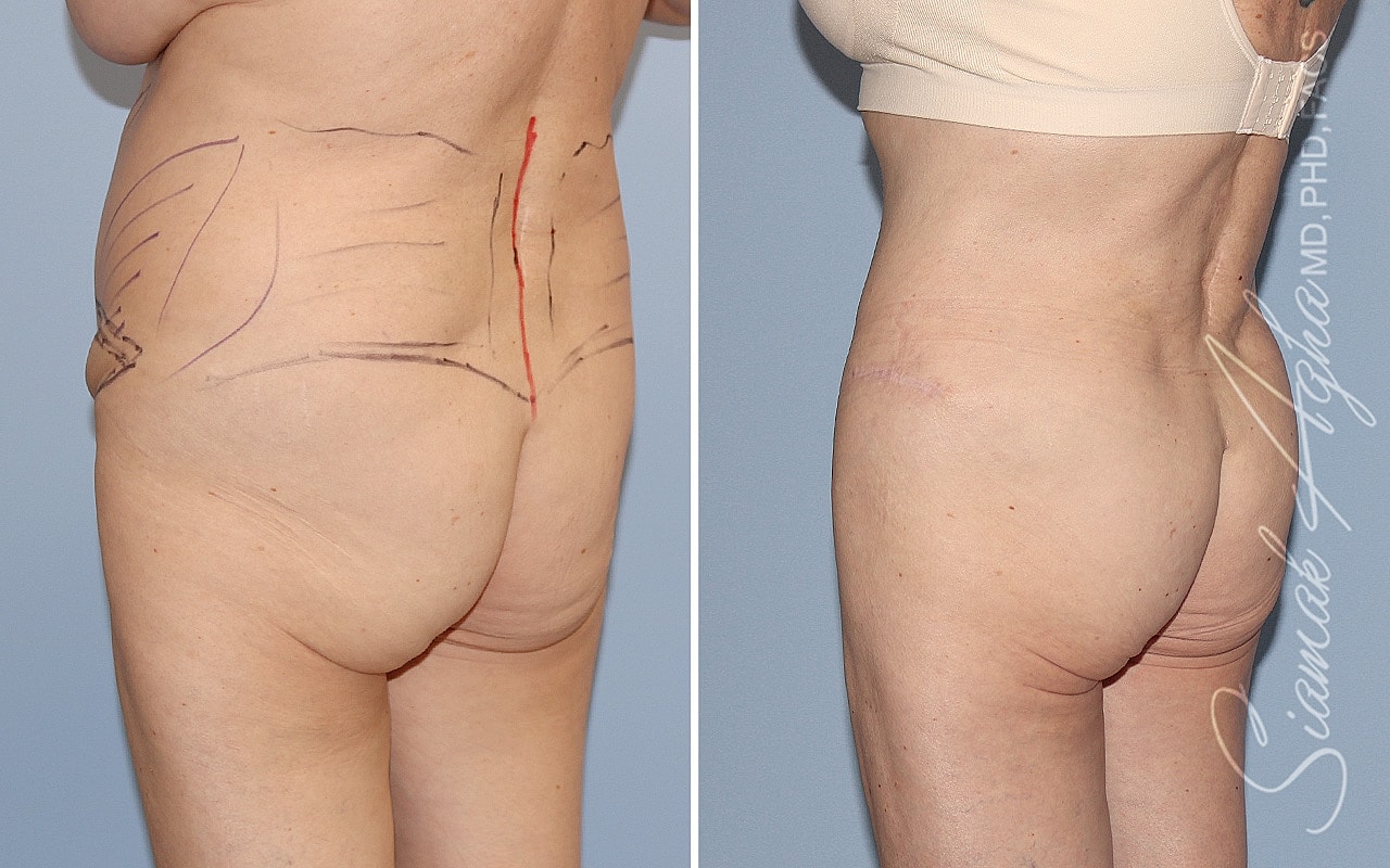 Plus Size Tummy Tuck Before & After