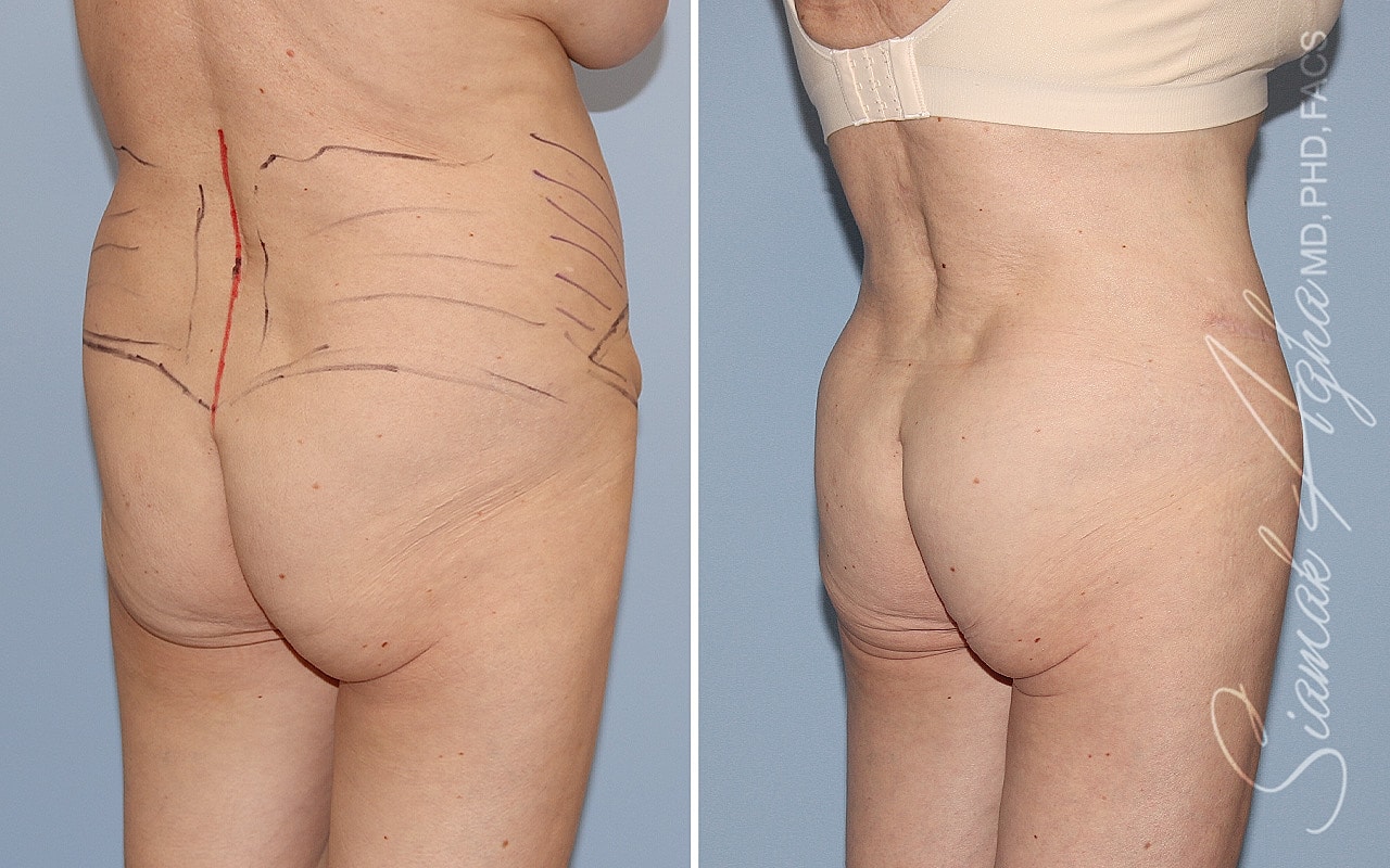 Plus Size Tummy Tuck Before & After