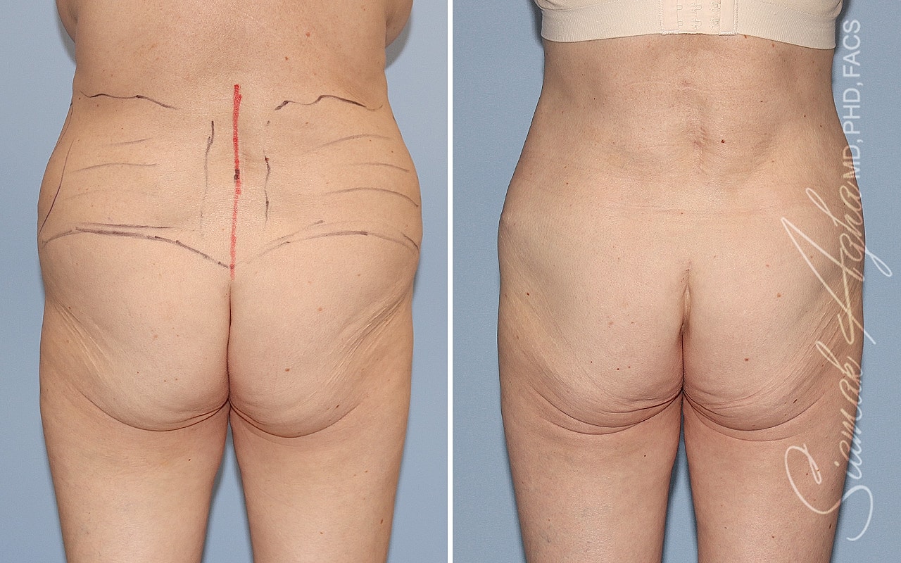 Plus Size Tummy Tuck Before & After
