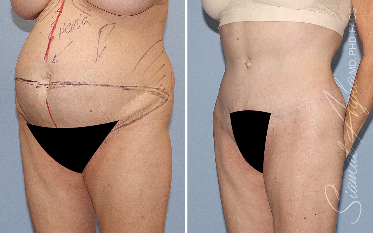 Plus Size Tummy Tuck Before & After