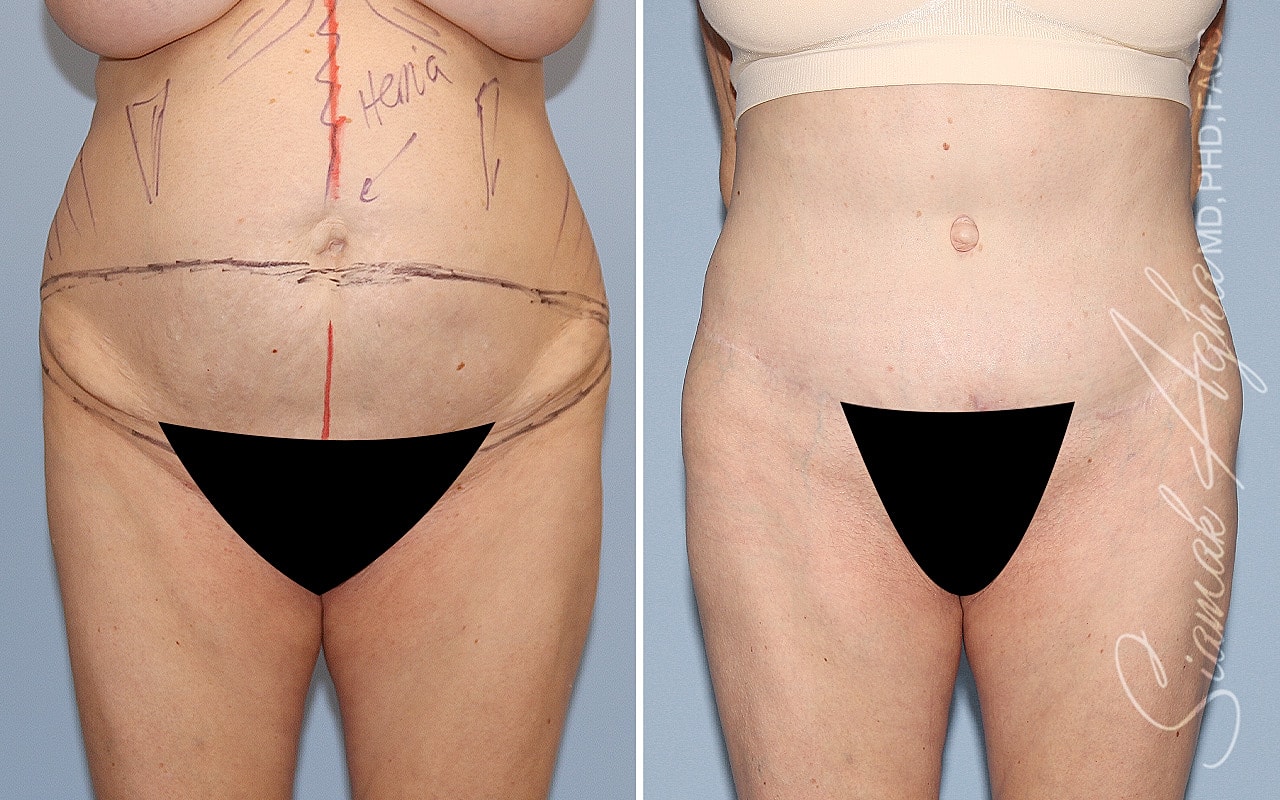 Plus Size Tummy Tuck Before & After