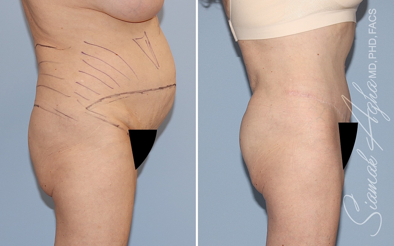 Plus Size Tummy Tuck Before & After