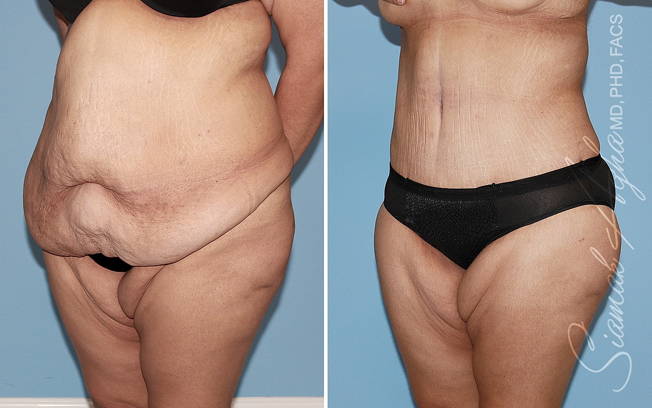 Plus Size Tummy Tuck Before & After