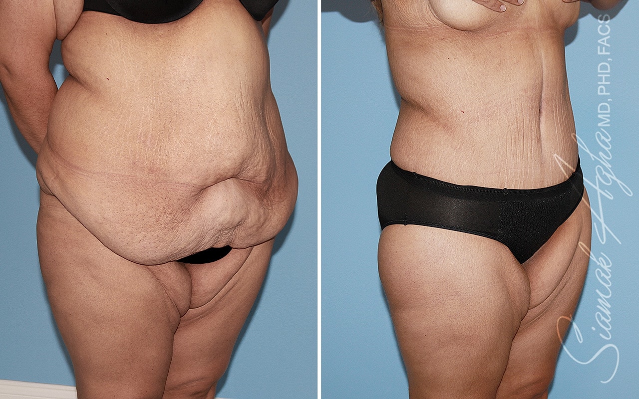 Plus Size Tummy Tuck Before & After