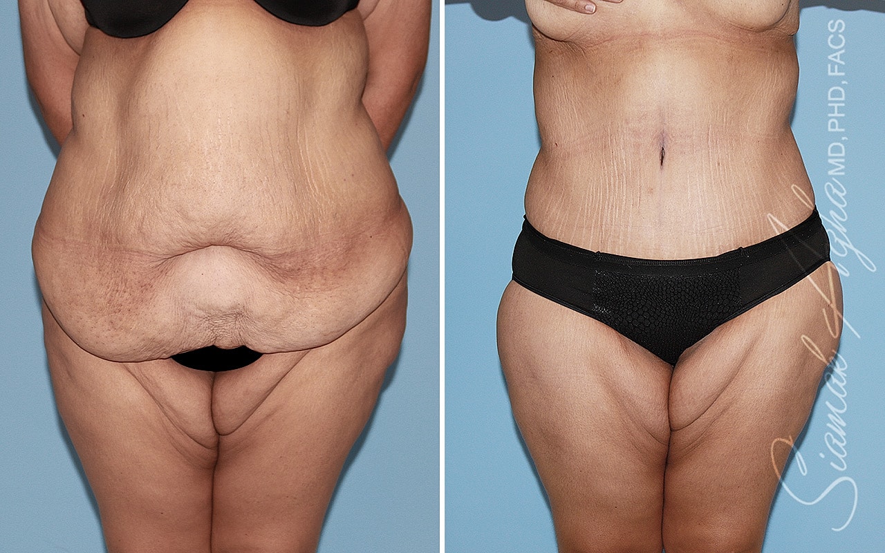 Plus Size Tummy Tuck Before & After