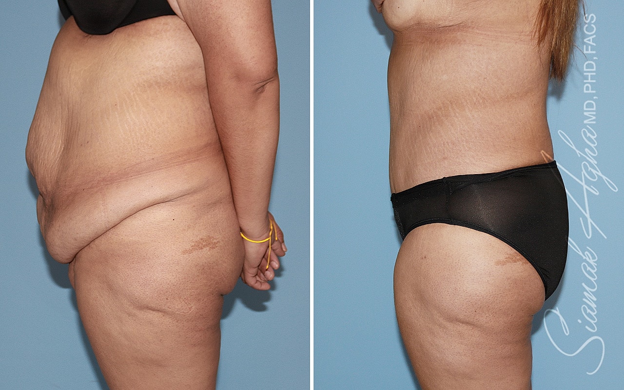 Plus Size Tummy Tuck Before & After