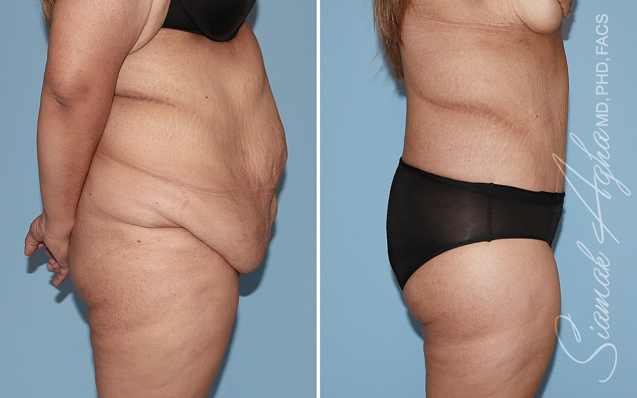 Plus Size Tummy Tuck Before & After