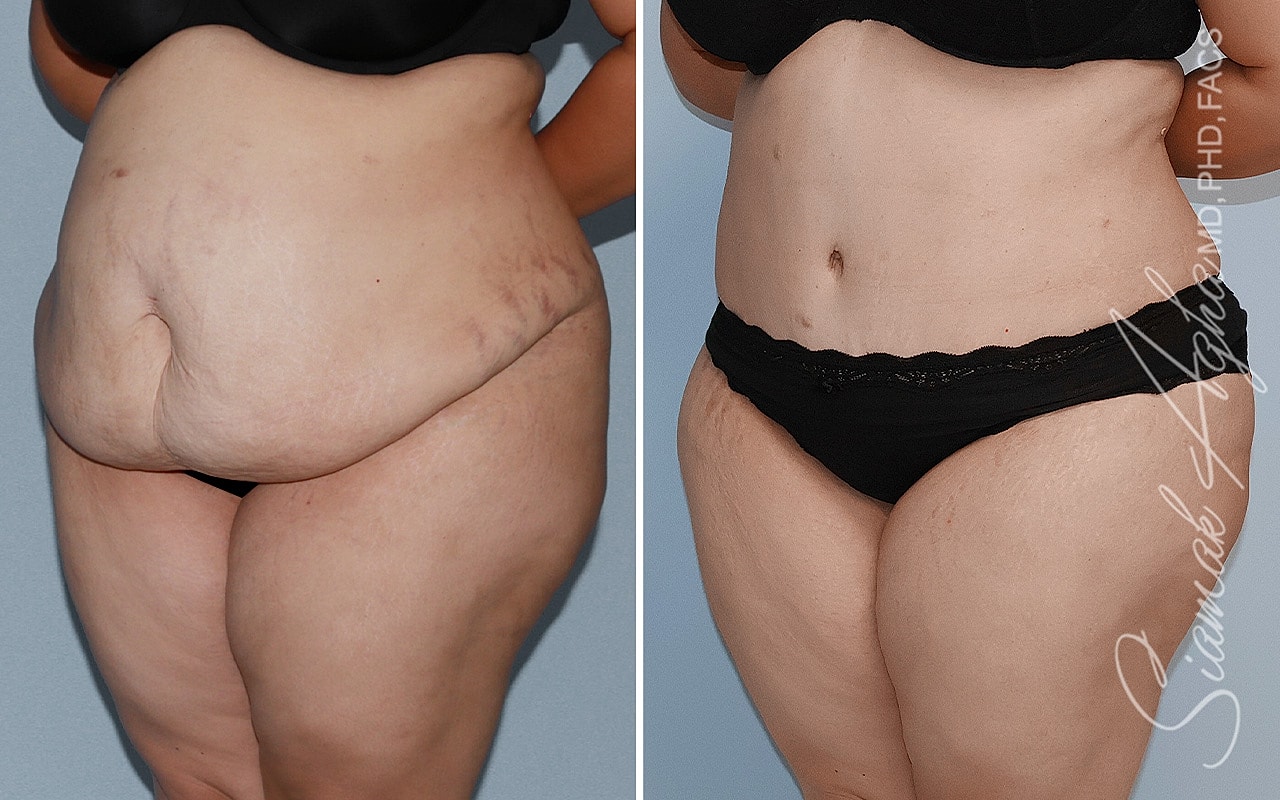 Plus Size Tummy Tuck Before & After
